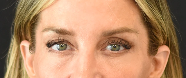 Eyelid Surgery Patient 23 Set 1 After