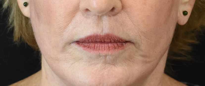 Lip Lift Patient 10 Set 1 After